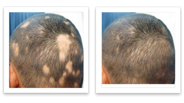 Caboki 10X Hair Powder - Enhances Hairline, Hair Volume, Root Touch Up. Talc-Free, Mica-Free.