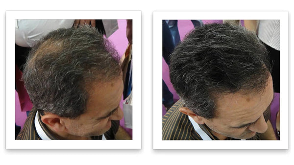 Before and after image of a man with short wavy black hair with a bald spot on his crown
