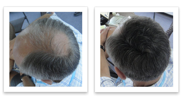 Before and after image of a man with a short straight black hair and a bald spot on his crown