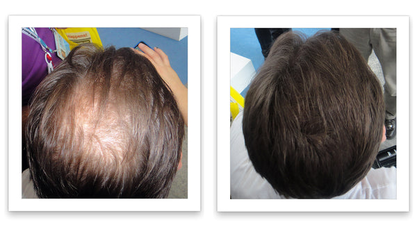 Before and after image of a man with straight dark brown hair who has a bald spot on his crown