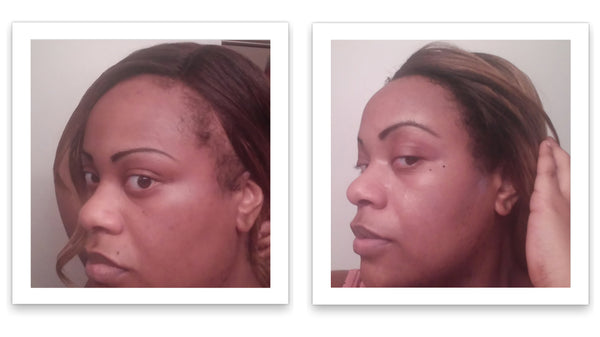 Before and after image of a woman long straight brown hair with thin hair on her hairline